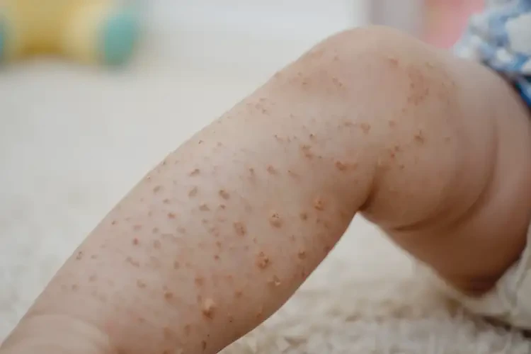 幼儿小腿偶尔长湿疹不管它会自己好吗(图4)