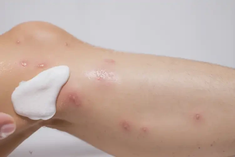 男人小腿容易長濕疹可不可以徹底自愈(圖3)