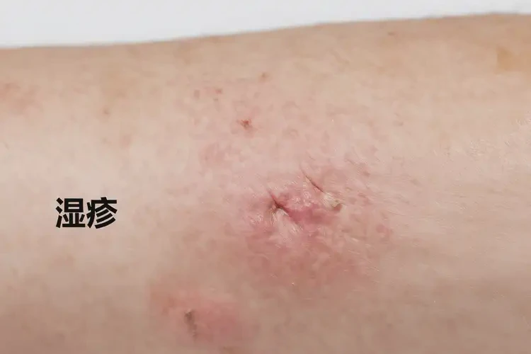 女人手臂上起濕疹能徹底自愈嗎(圖4)