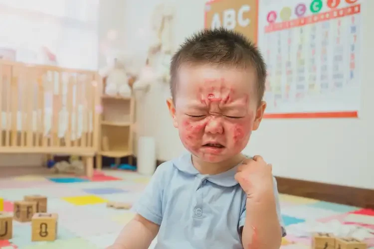 幼兒臉上偶爾起濕疹不管它會自己痊愈嗎(圖1)