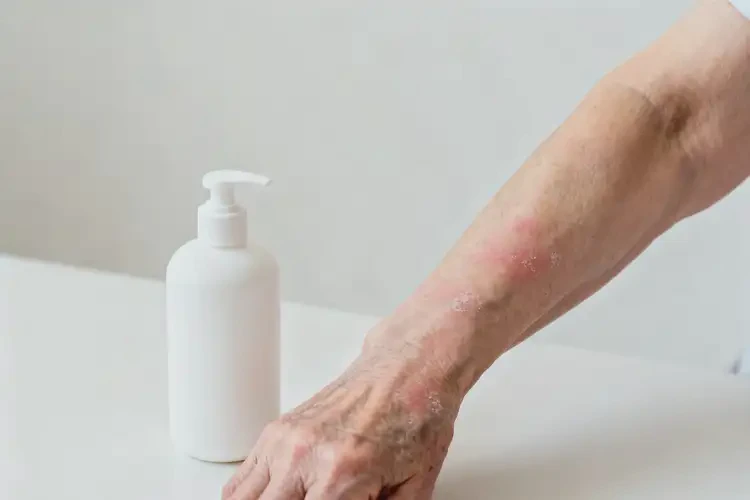 老年人手臂上容易长湿疹不管它会自己好吗(图4)