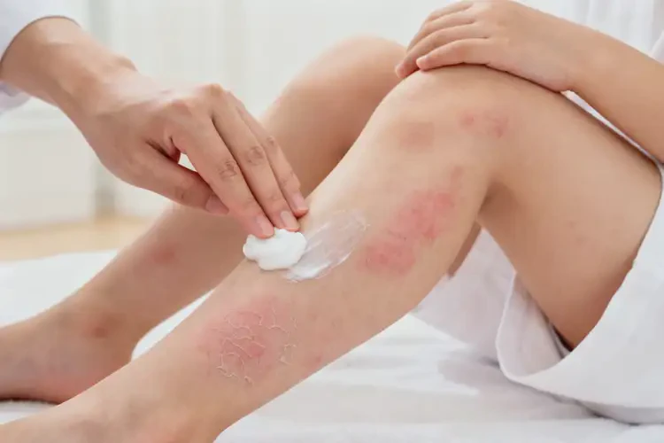 少兒小腿上有濕疹不管它會(huì)自己自愈嗎(圖1)