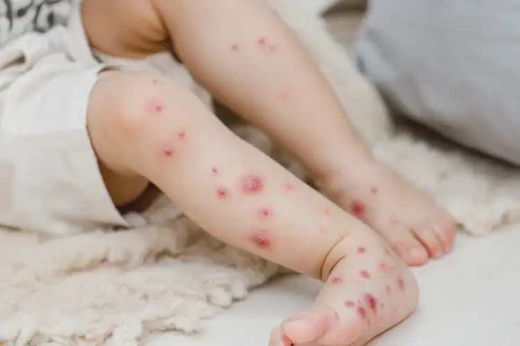 孩子小腿容易長(zhǎng)濕疹能夠徹底治愈嗎(圖3)