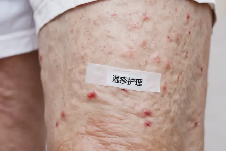 高齡老人大腿上經(jīng)常起濕疹可以徹底自愈嗎(圖4)