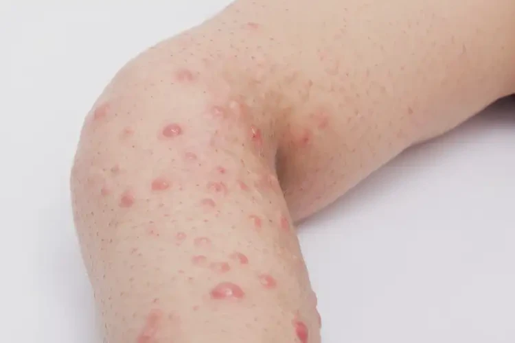 少兒四肢起濕疹不管它會自己痊愈嗎(圖3)