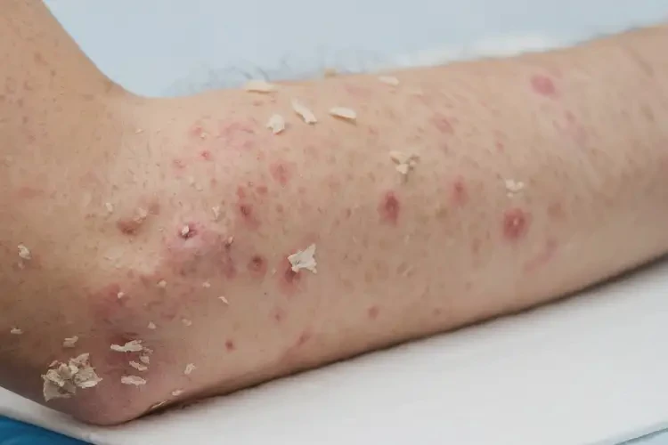 女人手臂上容易長濕疹能徹底自愈嗎(圖3)