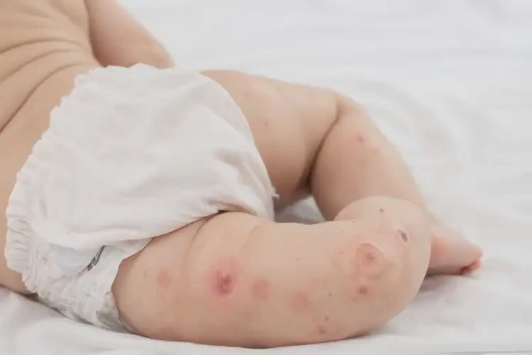 兒童屁股偶爾起濕疹可以徹底自愈嗎(圖4)