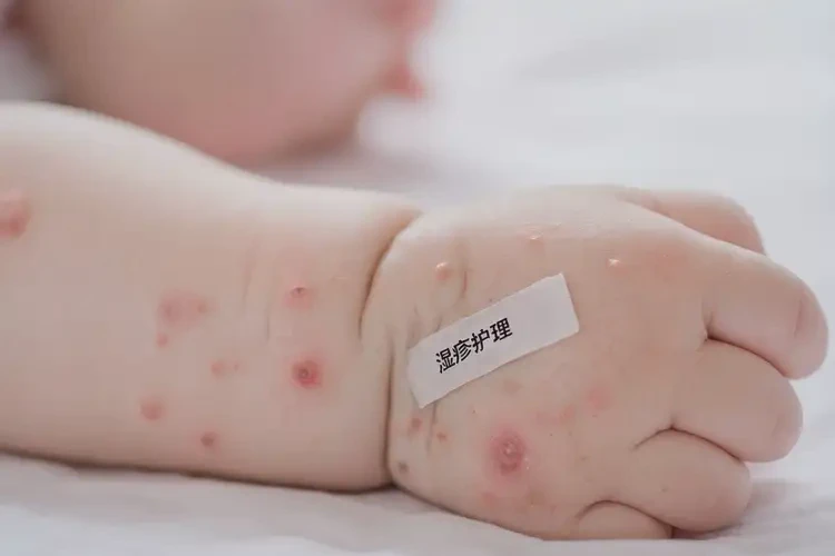 婴儿手臂起湿疹能彻底自愈吗(图4)