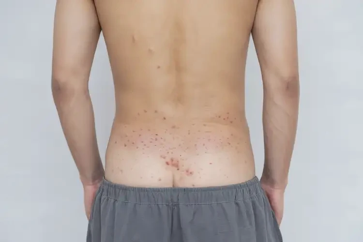 男生屁股长湿疹可以彻底自愈吗(图4)