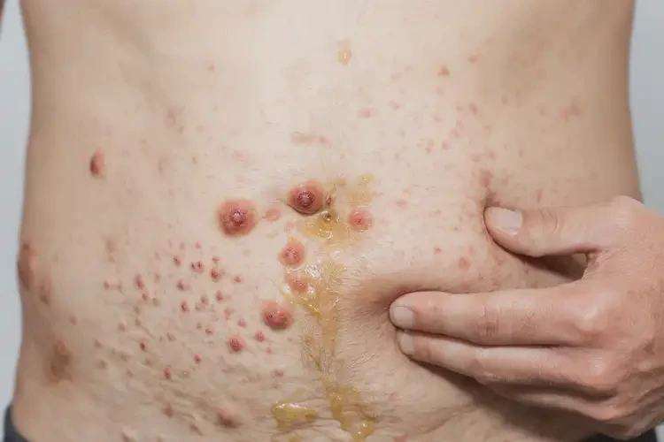 男性肚子偶爾起濕疹不管它會自己好嗎(圖3)