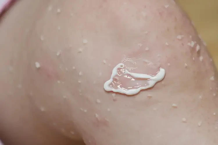 兒童小腿上有濕疹不管它會(huì)自己痊愈嗎(圖2)