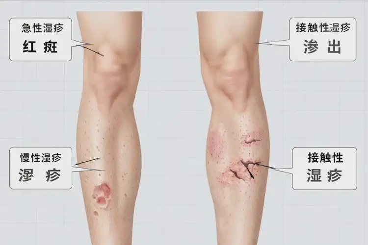 青年人大腿上長濕疹可以徹底自愈嗎(圖3)