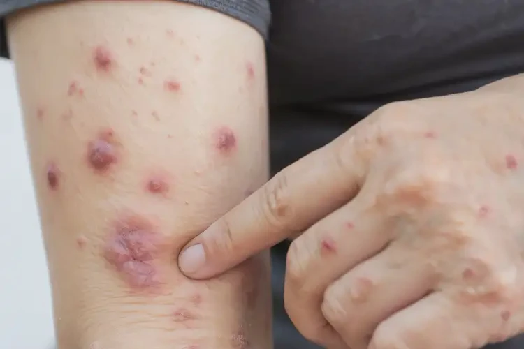 女性手臂经常长湿疹可不可以彻底自愈(图4)