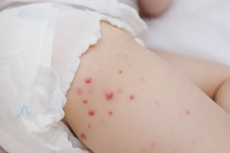 嬰兒屁股出現(xiàn)濕疹可不可以徹底自愈(圖4)