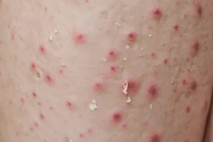 中學(xué)生大腿上出濕疹能徹底自愈嗎(圖4)