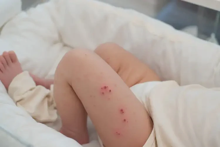 新生兒大腿上出濕疹能靠自己自愈嗎(圖3)