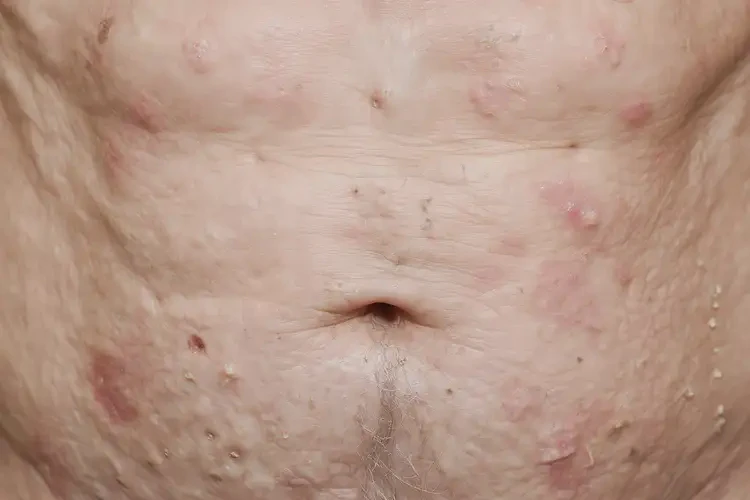 高齡老人肚子上出現(xiàn)濕疹可不可以徹底自愈(圖4)