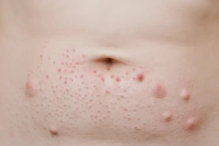 女人肚子上经常起湿疹可以彻底自愈吗(图4)