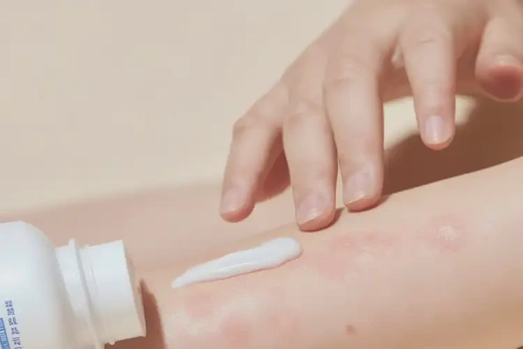 幼兒手臂有濕疹不管它會自己好嗎(圖1)