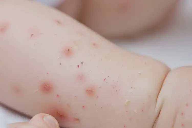 嬰兒手臂上長(zhǎng)濕疹可以徹底自愈嗎(圖4)