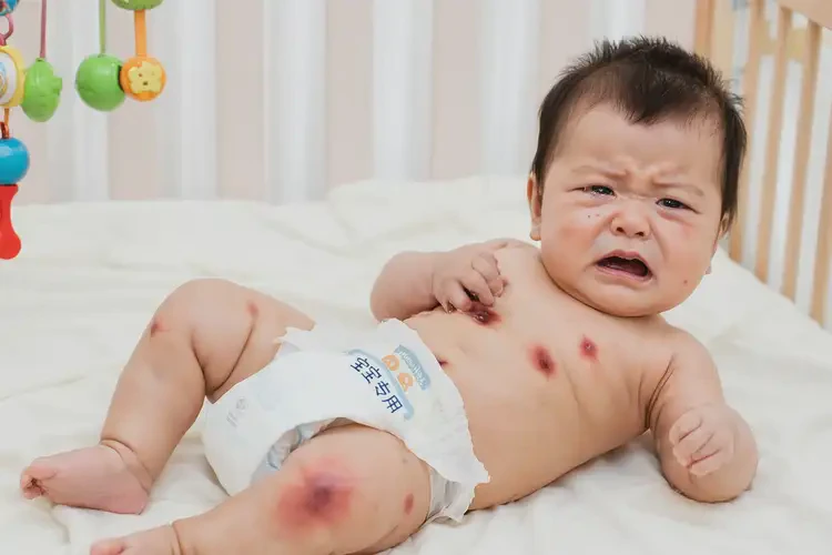 小孩屁股经常起湿疹可以彻底自愈吗(图4)