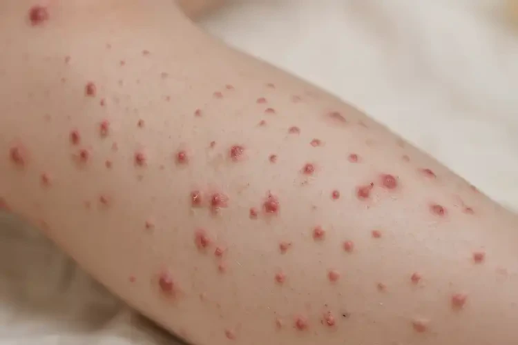 孩子大腿上出濕疹不管它會自己自愈嗎(圖3)