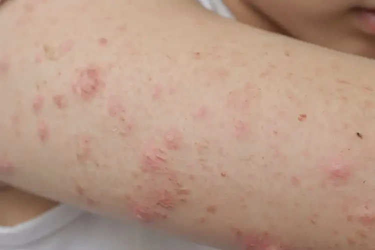 青少年身上偶爾起濕疹能靠自己自愈嗎(圖4)