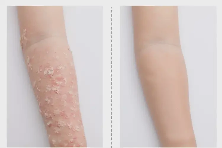 兒童屁股上偶爾長(zhǎng)濕疹不管它會(huì)自己好嗎(圖2)