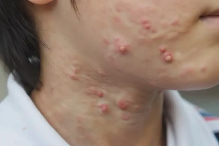 中學(xué)生脖子上容易起濕疹不管它會(huì)自己自愈嗎(圖3)