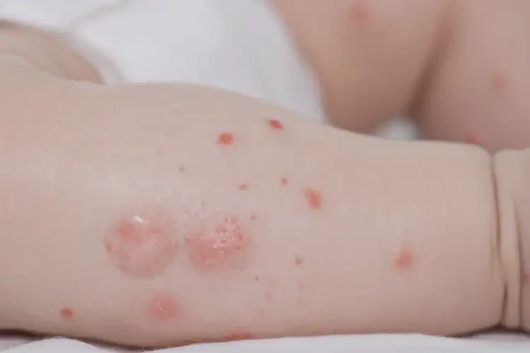 嬰兒小腿容易長濕疹能徹底自愈嗎(圖4)