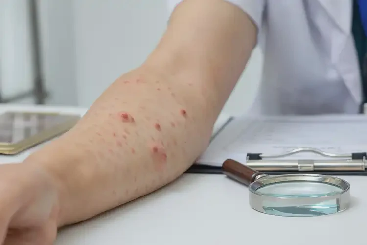 青少年手臂上容易起湿疹不管它会自己自愈吗(图3)