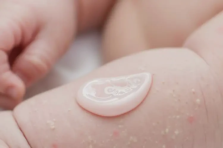 新生兒手臂上出濕疹不管它會(huì)自己好嗎(圖2)