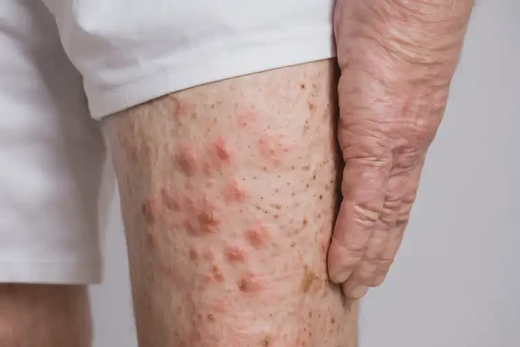 老人大腿經(jīng)常起濕疹不管它會自己痊愈嗎(圖4)