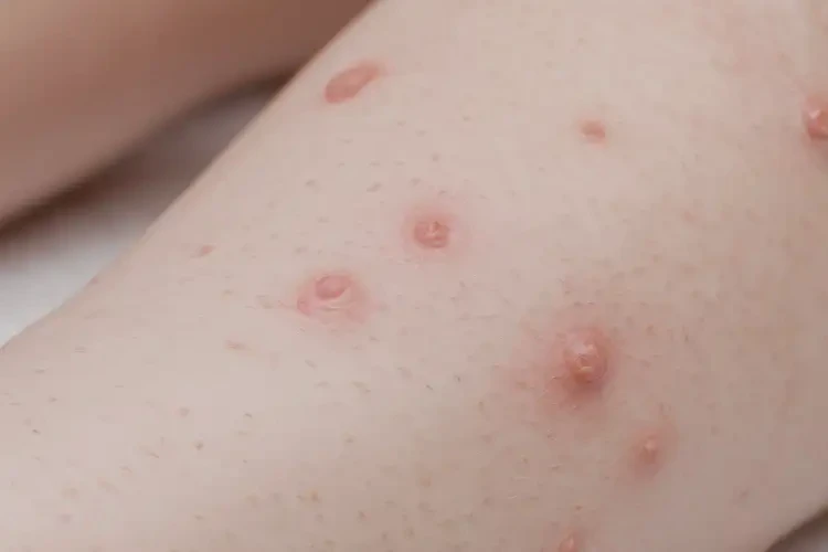 小兒小腿上偶爾起濕疹不管它會自己自愈嗎(圖4)