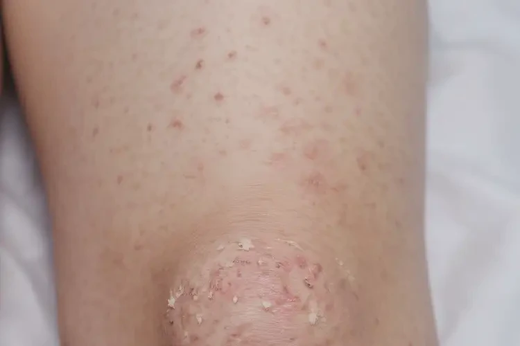 小孩大腿上容易起濕疹不管它會自己痊愈嗎(圖3)