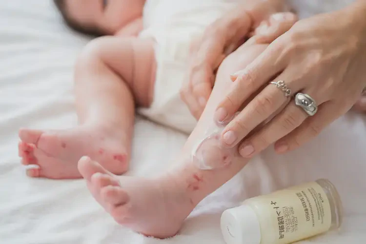 新生兒小腿偶爾起濕疹可不可以徹底自愈(圖3)