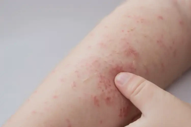 少儿身上偶尔长湿疹不管它会自己痊愈吗(图4)