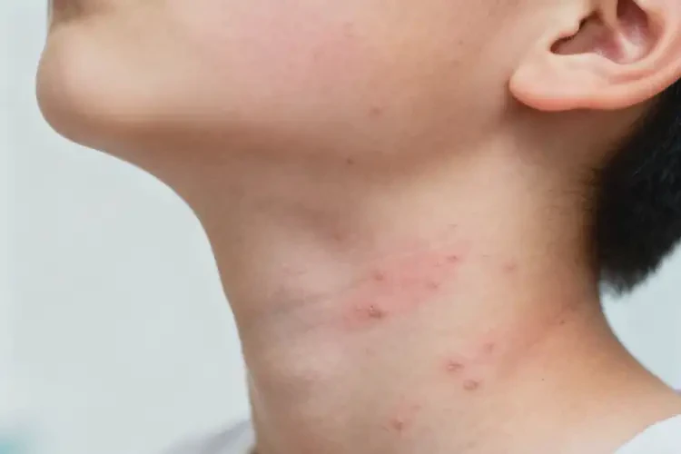 青少年脖子經常起濕疹不管它會自己自愈嗎(圖2)