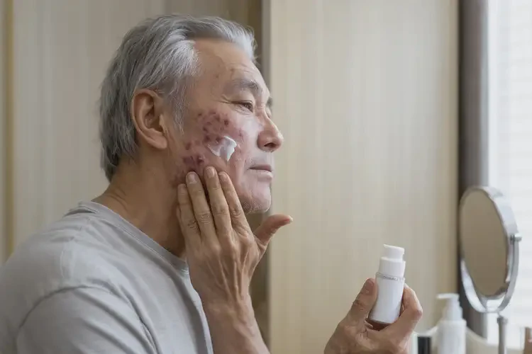 老年人面部容易长湿疹能彻底自愈吗(图3)