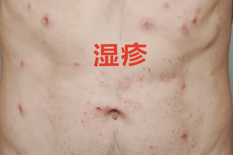 男人肚子出湿疹能够彻底治愈吗(图4)