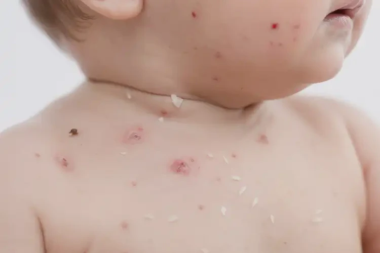 宝宝脖子起湿疹不管它会自己痊愈吗(图2)