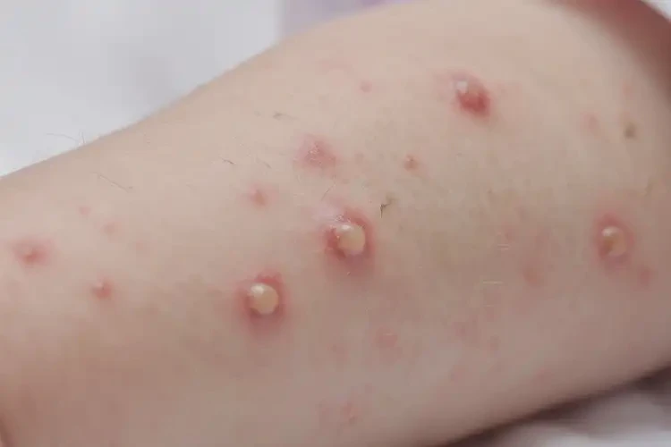 嬰幼兒手臂上偶爾起濕疹能夠徹底治愈嗎(圖3)