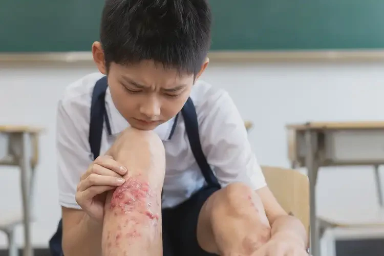 中学生小腿容易长湿疹可不可以彻底自愈(图4)