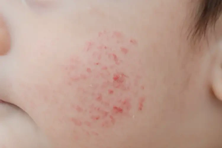 寶寶肛周容易長濕疹可不可以徹底自愈(圖4)