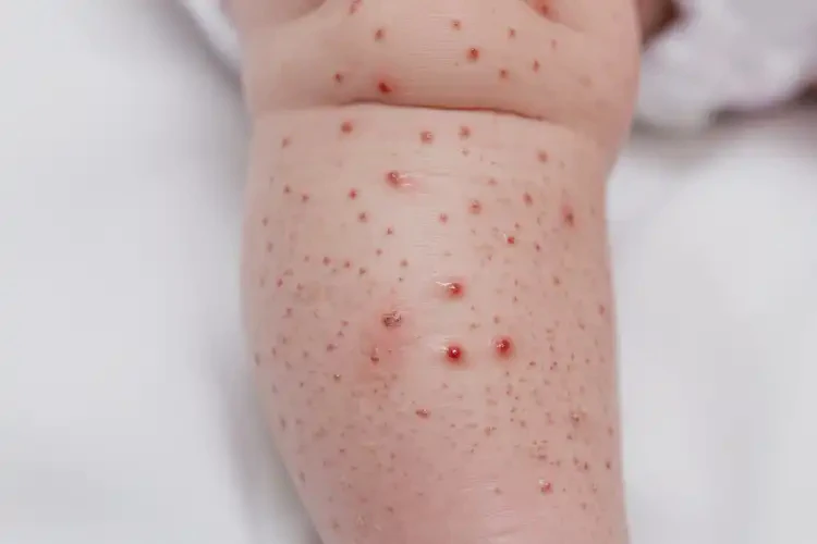 新生兒小腿出現(xiàn)濕疹不管它會(huì)自己自愈嗎(圖3)