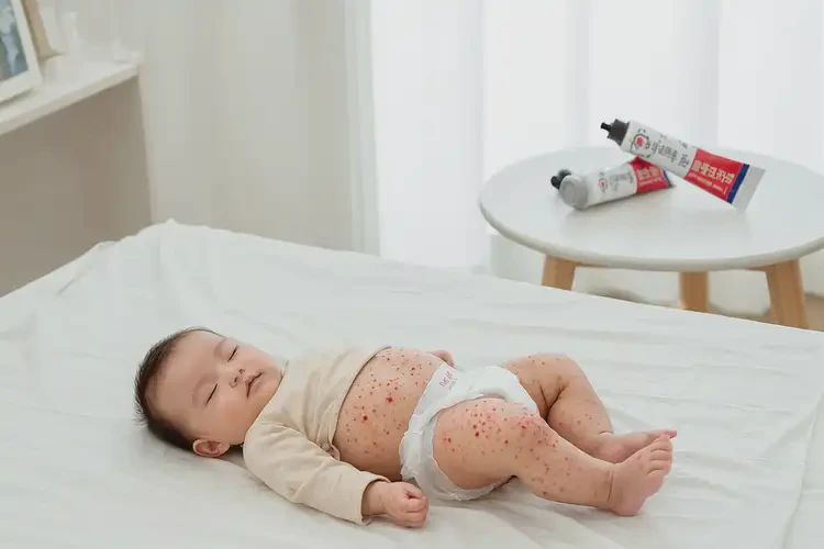 新生兒屁股經(jīng)常起濕疹不管它會自己好嗎(圖1)