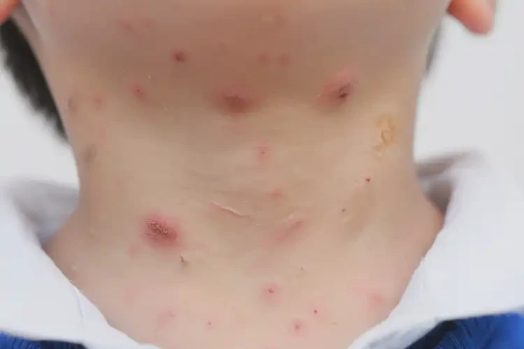 小學(xué)生脖子上容易長(zhǎng)濕疹不管它會(huì)自己痊愈嗎(圖4)