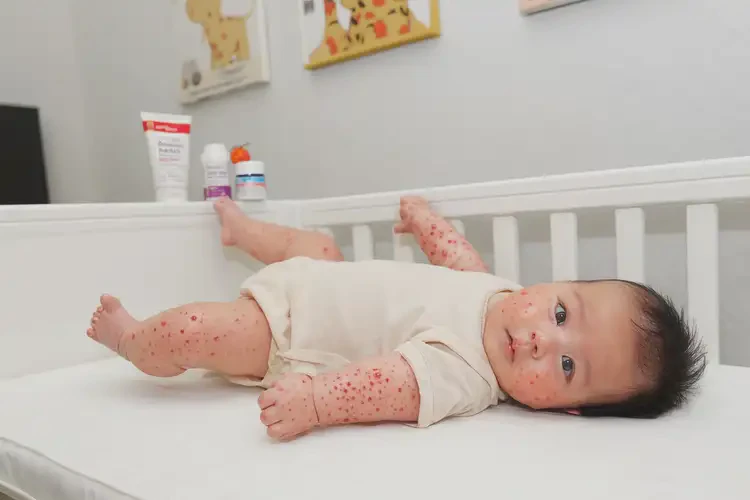 婴幼儿四肢容易起湿疹能靠自己自愈吗(图4)