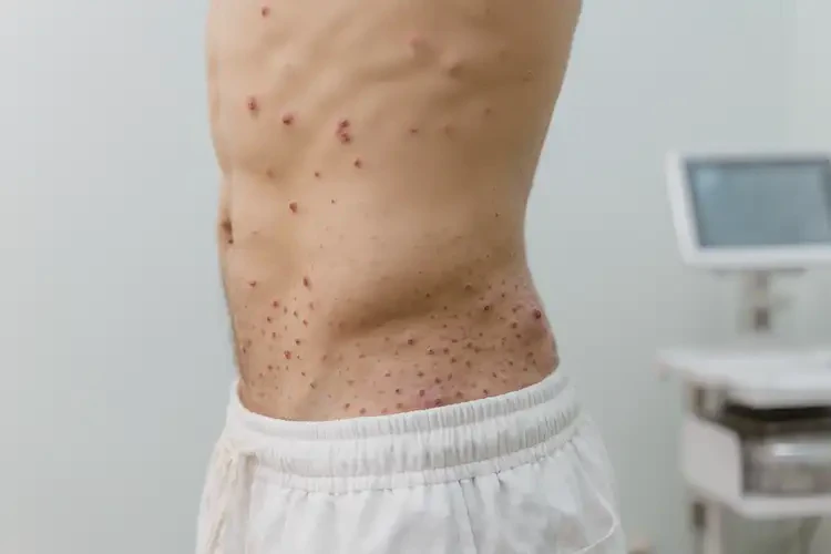 青年人屁股起濕疹不管它會(huì)自己自愈嗎(圖4)