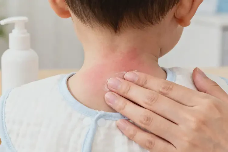 孩子脖子长湿疹可以彻底自愈吗(图1)